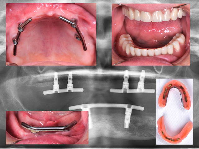lunch na school Zenuwinzinking Tandwortel implantaten voor houvast van het kunstgebit in de bovenkaak lunch na school Zenuwinzinking Tandwortel implantaten voor houvast van het kunstgebit in de bovenkaak